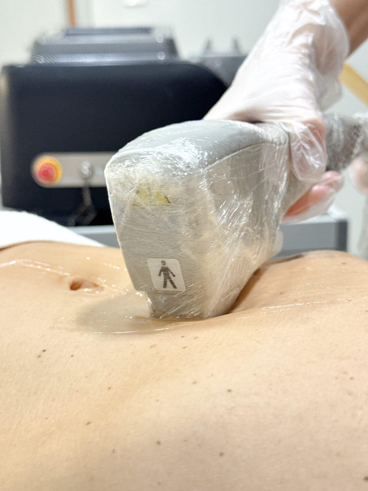 Depilação a Laser - Linha Alba