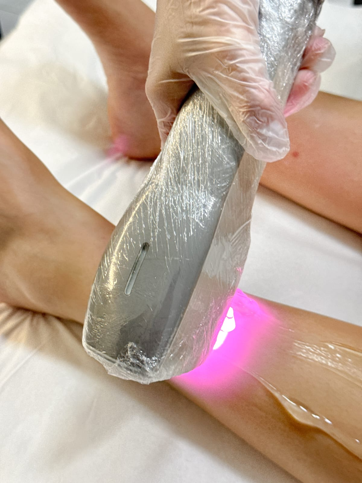 Depilação a Laser - Pernas