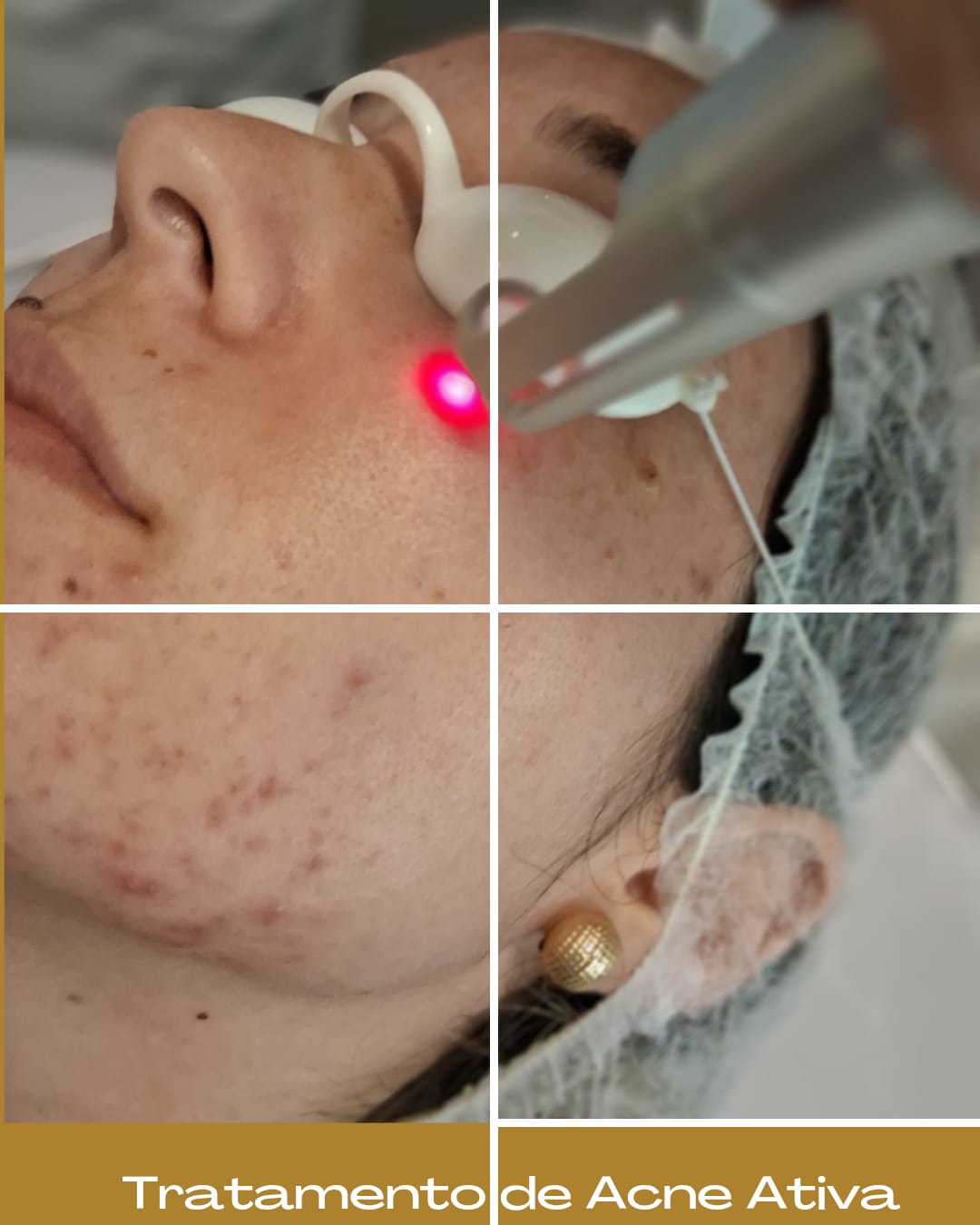 Tratamento de Acne Ativa com Helius
