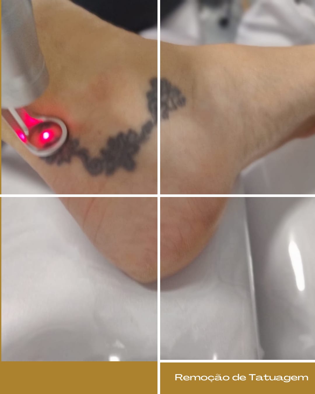 Remoção de Tatuagem com Helius