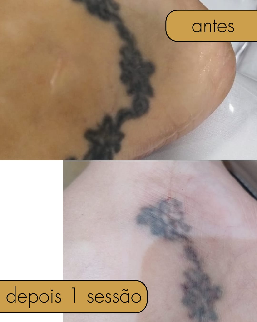 Antes e Depois - Remoção de Tatuagem