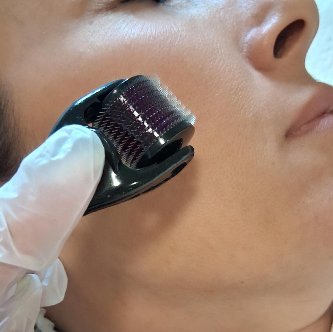 Microagulhamento Facial