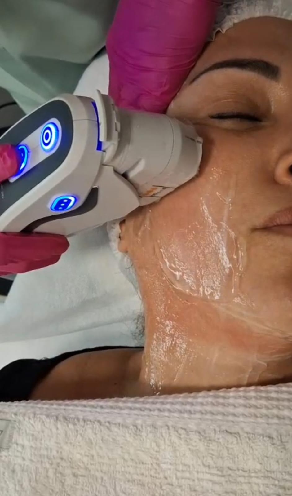 Ultrassom Microfocado